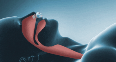 Micro CPAP - Draagbaar Apparaat voor Stille en Compacte Slaapapneu